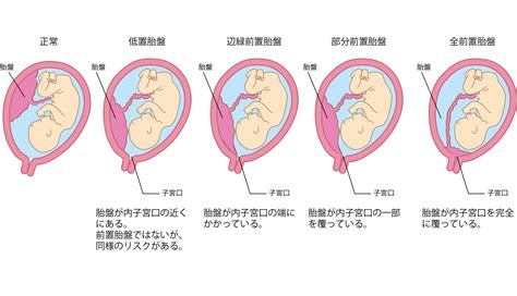 前置胎盤改善